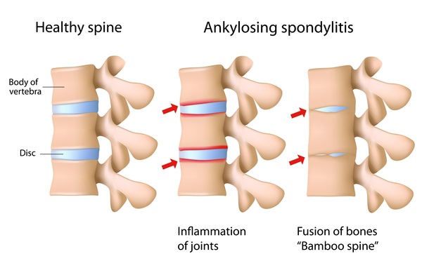 Get Effective Ankylosing Spondylitis Homeopathy Treatment in India