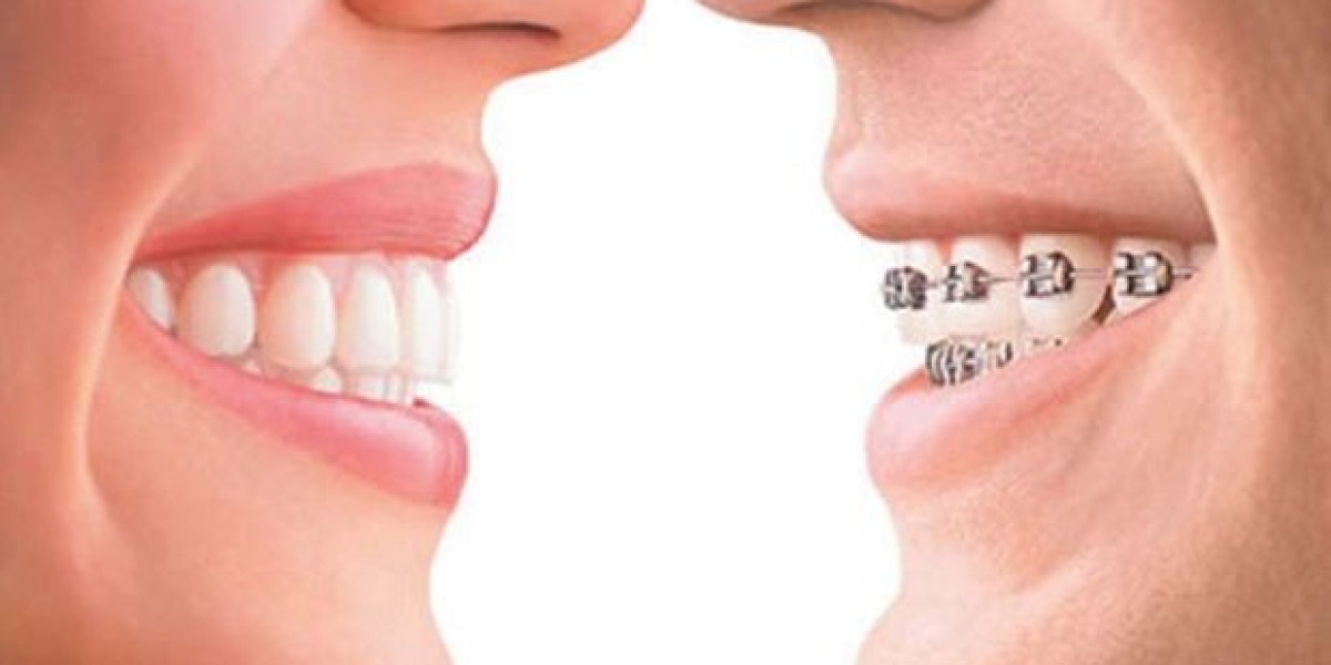 Invisalign vs. Braces: A Comprehensive Guide to Dental Services