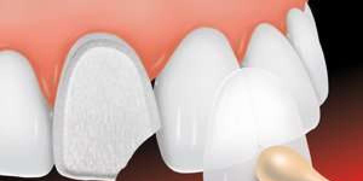 The Benefits of Dental Veneers: Transform Your Smile with Confidence