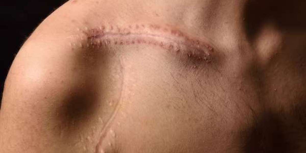 Are you looking for a Scar treatment in Delhi ?