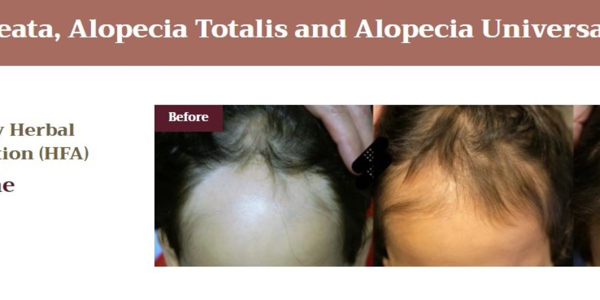 Androgenic Alopecia Cure: A Comprehensive Guide