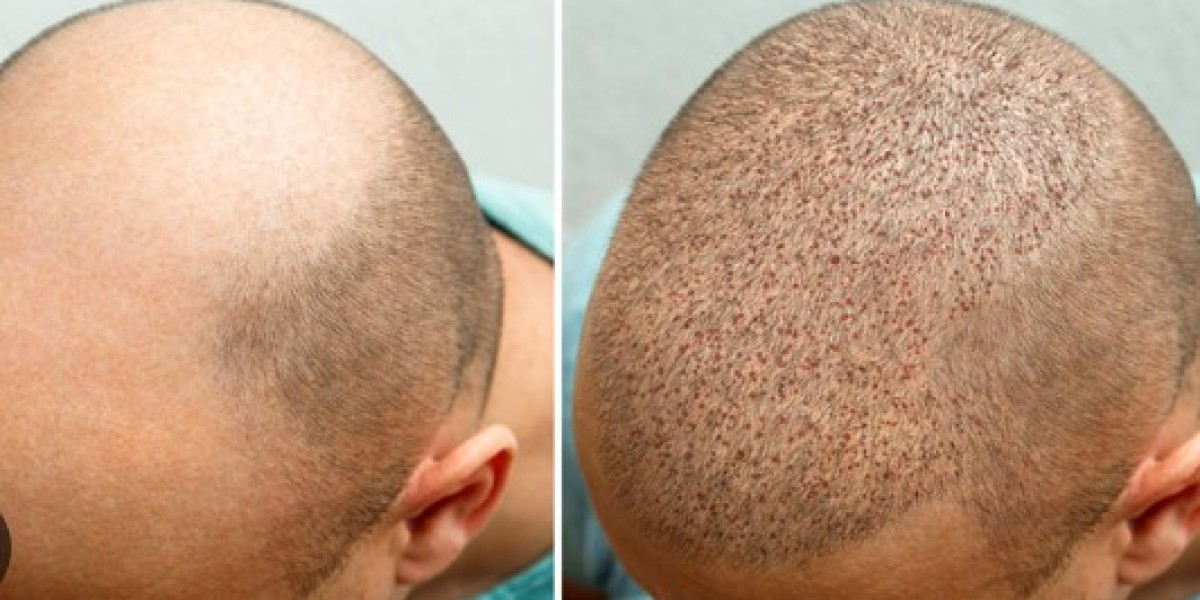Best Hair Transplant Clinic in Bangalore