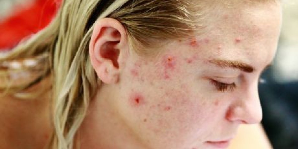 Skin Purging nach Tretinoin: Die Erstverschlimmerung auf dem Weg zu reiner Haut