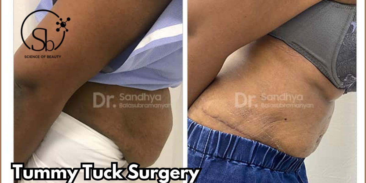 Can Tummy Tuck Give One an Hourglass Figure?