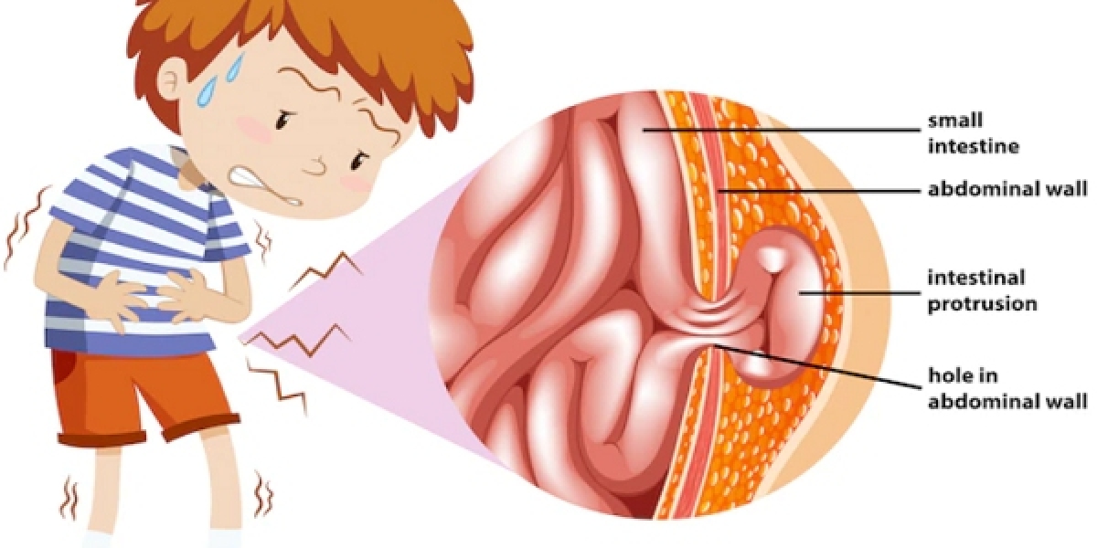 Best Hernia Surgeon in Hyderabad | Dr. Datta Ram U