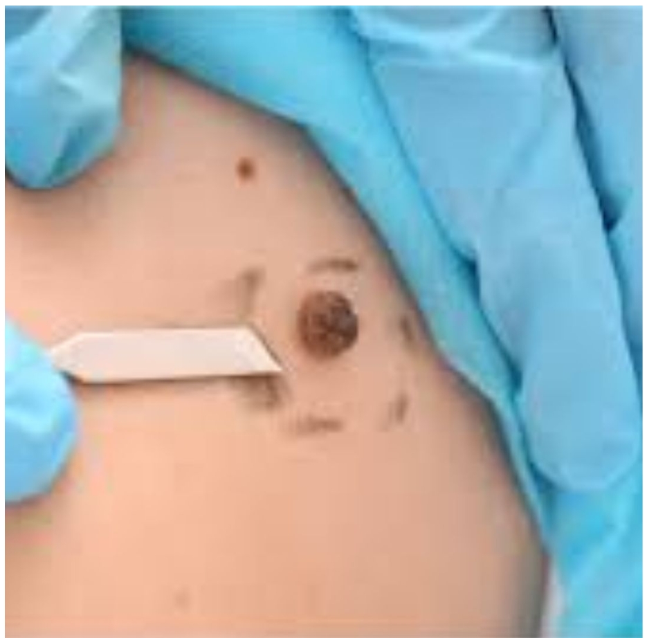 Skin Tag Removal: Effective Methods and What to Expect - Mating Press